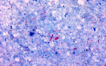 Mycobacterium tuberculosis Ziehl Niessen stain