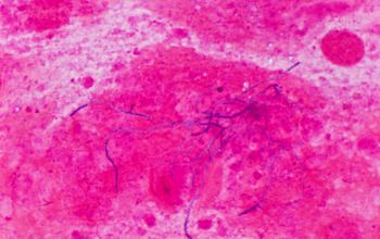 Nocardia farcinica Gram stain